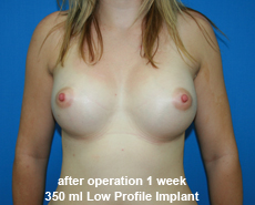 plastic-surgery-breast-augmentation